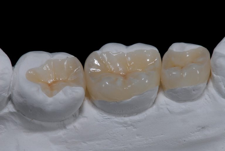 carillas-e-incrustaciones-dentales